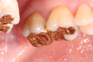 Gold Restorative Dentistry