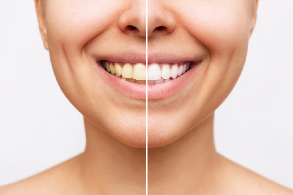 Teeth Whitening Clarksville, IN
